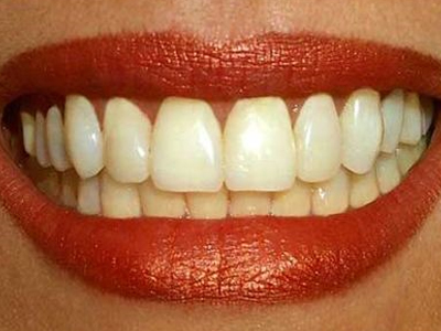 Κακοσμία του στόματος